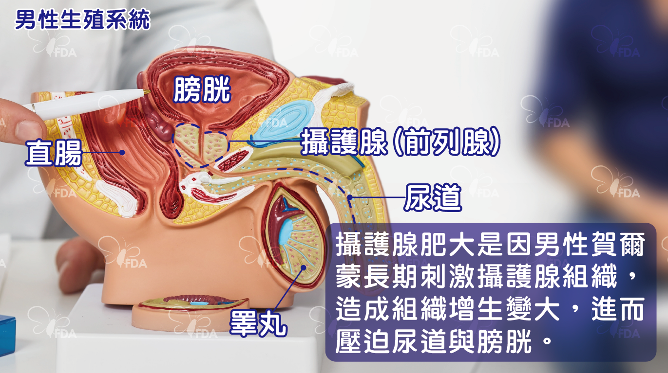 小便滴滴答答,攝護腺肥恐影響腎功能